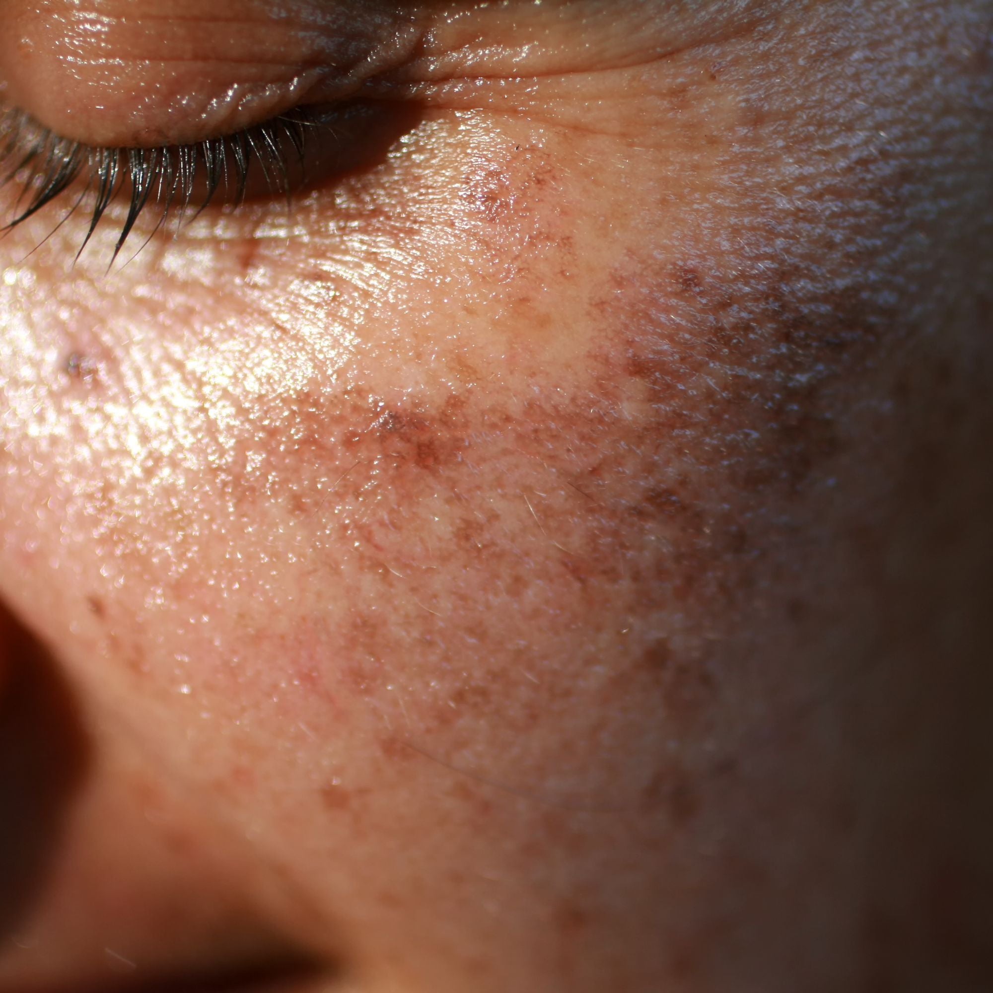 Protection contre les Dégâts Solaires: