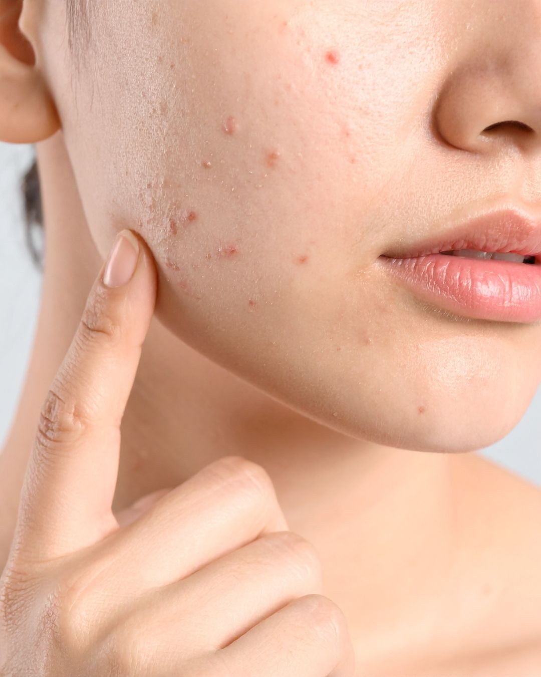 Rosacée et Couperose : Comment calmer le feu de votre visage naturellement ?