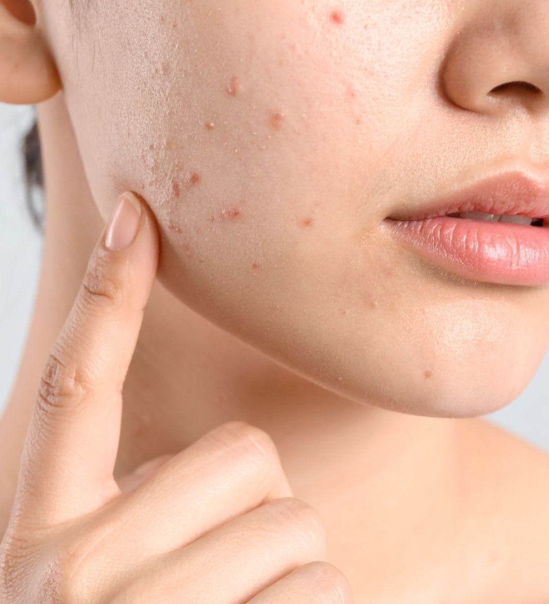 acne-hormonale-adulte-solution-naturelle-huile-noix