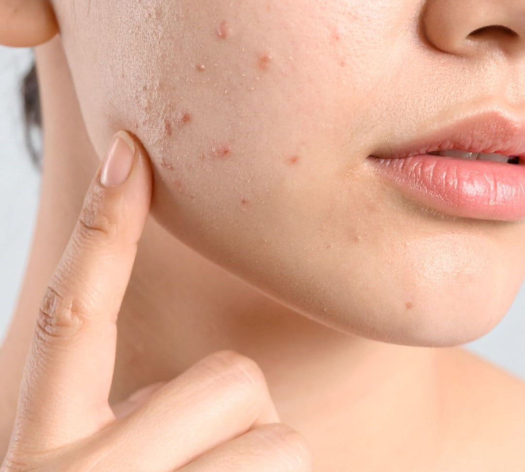 acne-hormonale-adulte-solution-naturelle-huile-noix