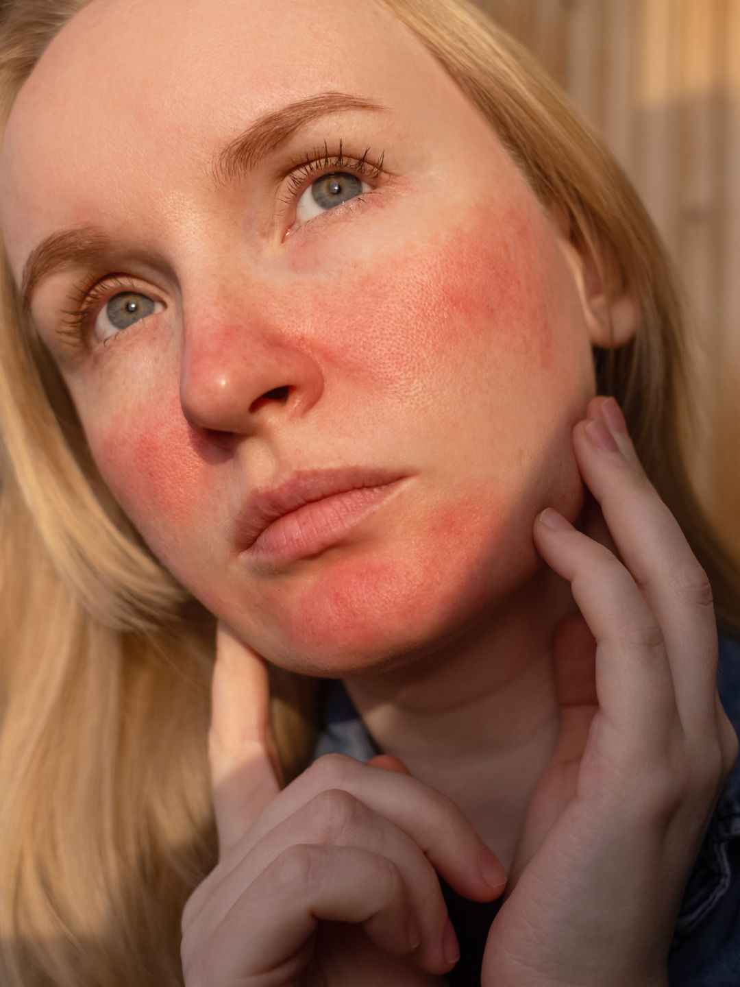 Femme appliquant un soin naturel pour diminuer les rougeurs de la rosacée et de la couperose sur les joues.