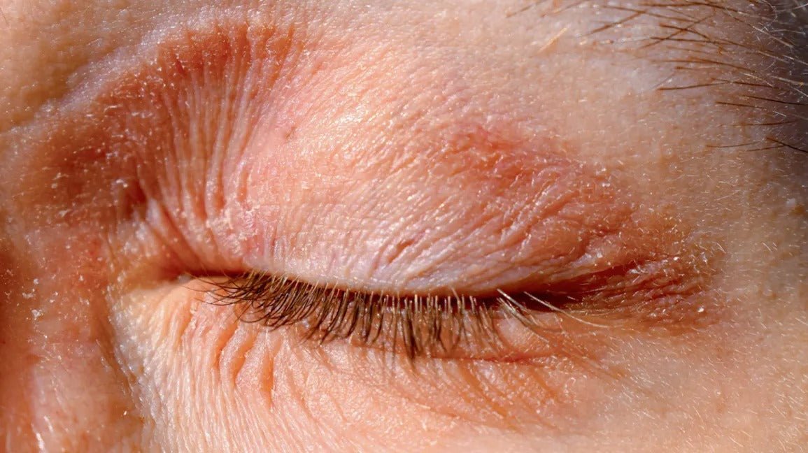 Comment diminuer et apaiser l'eczéma ? - Novëm