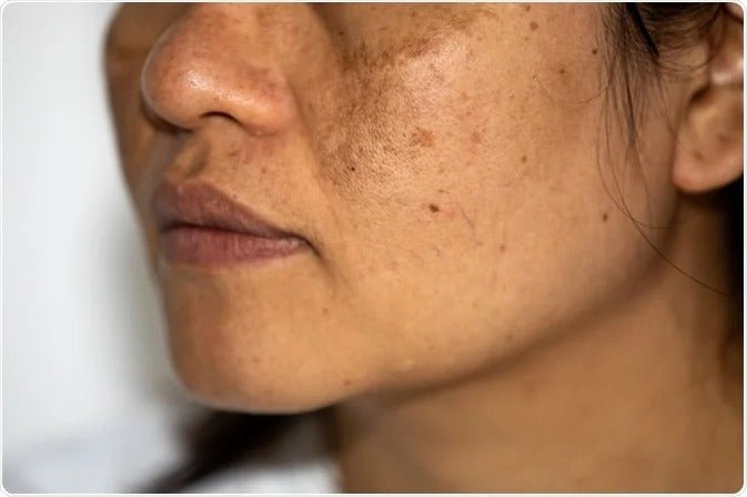 Comment enlever les tâches brunes sur la peau du visage ? - Novëm