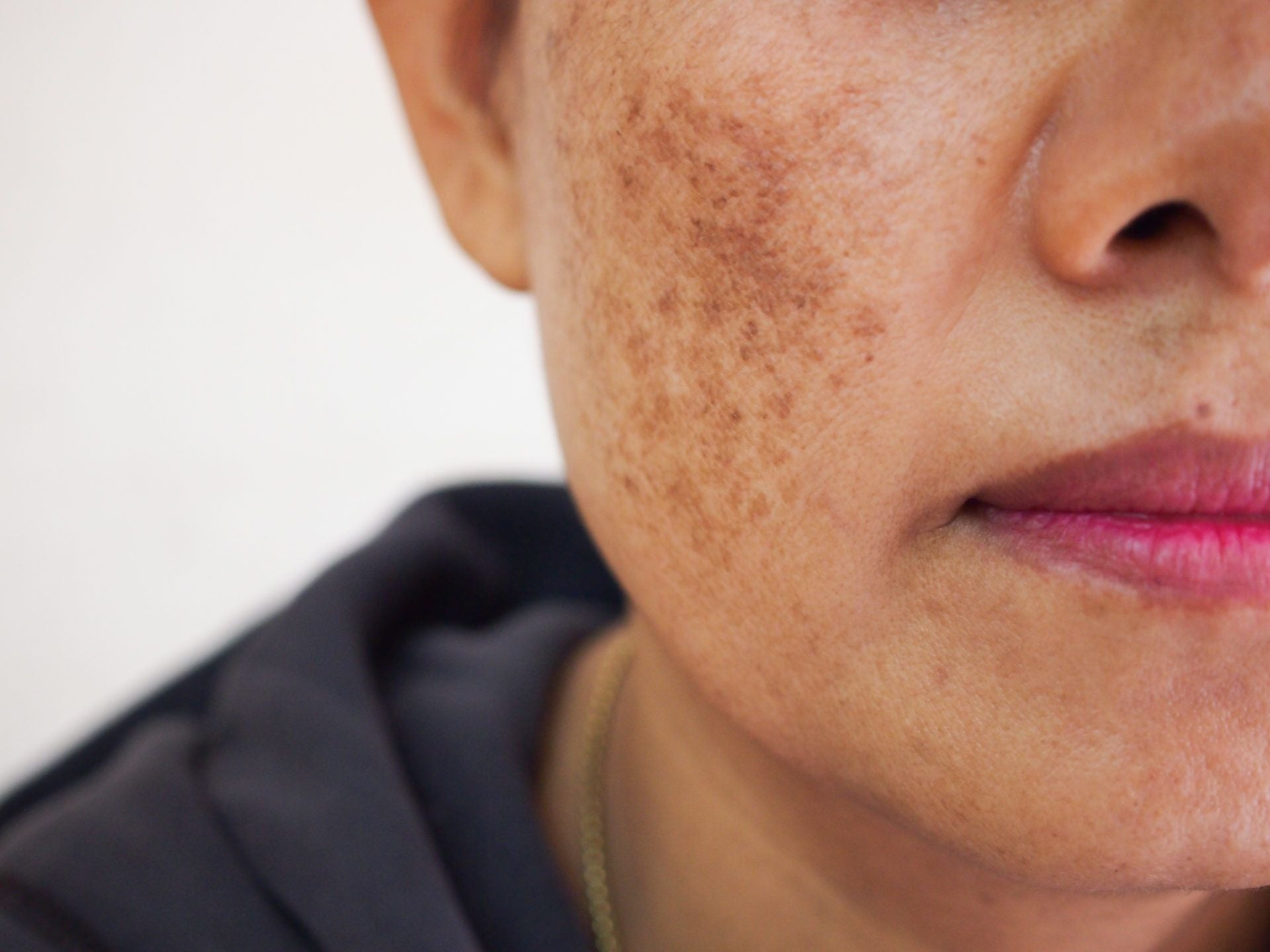 Comment lutter contre le masque de grossesse ? - Novëm