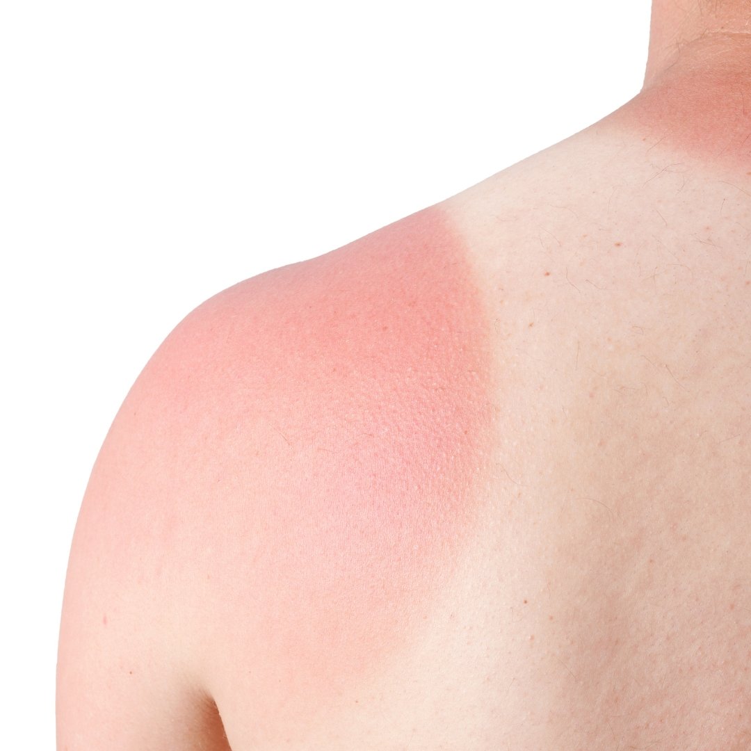 Comment soulager efficacement les coups de soleil: Guide complet et astuces pratiques - Novëm