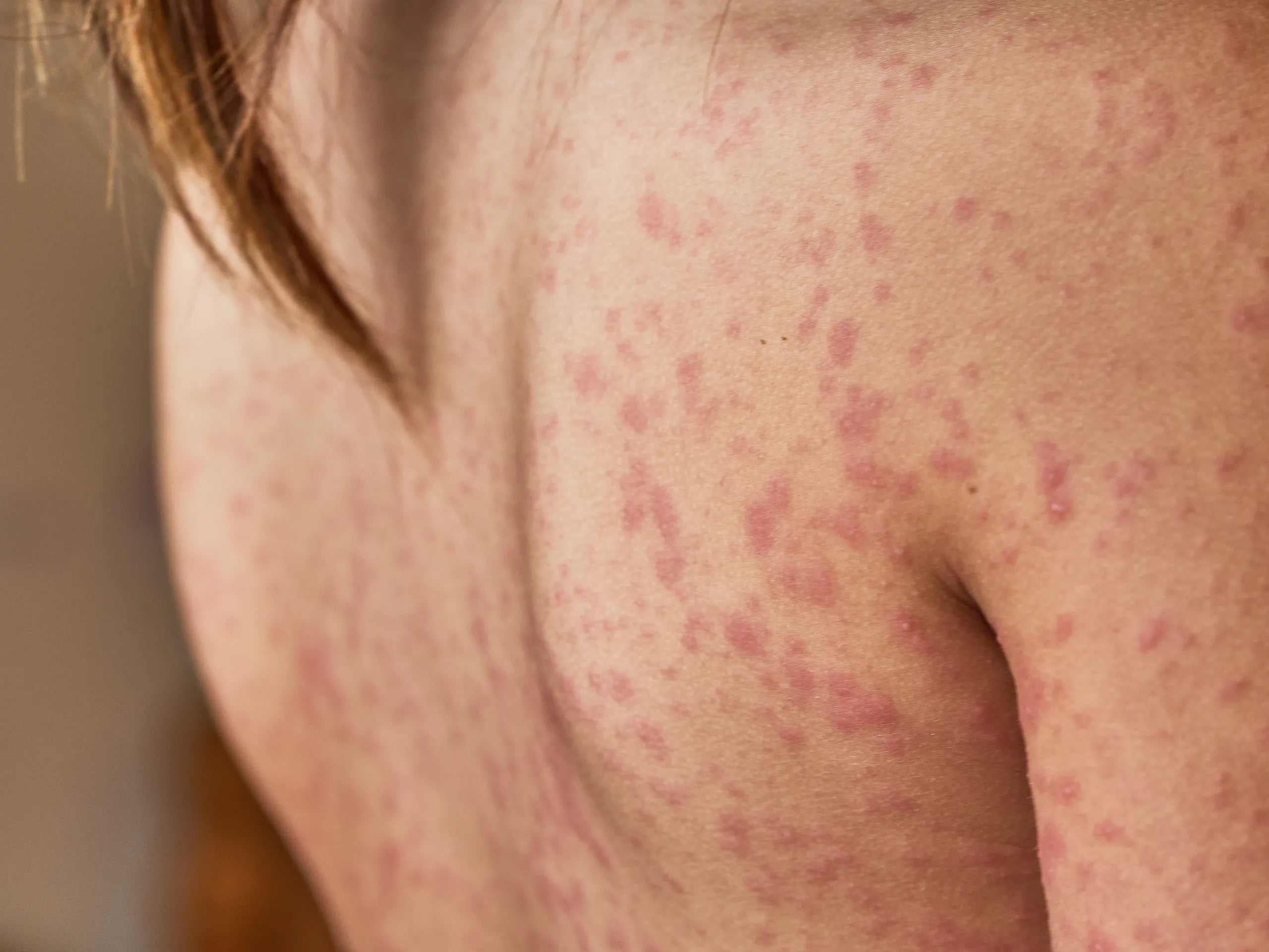 Le psoriasis, comment l'apaiser ? - Novëm