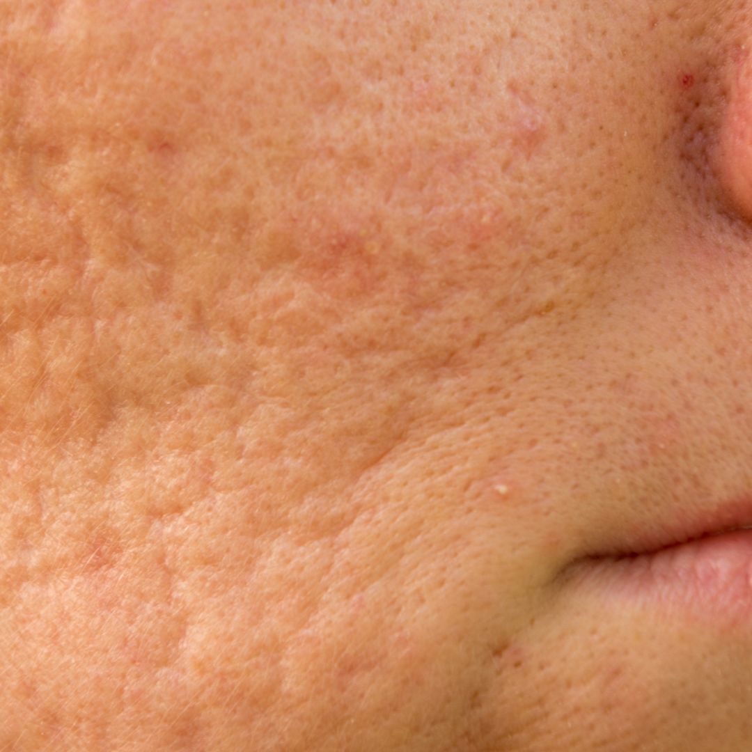 Les pores dilatés, comment s'en débarrasser ? - Novëm