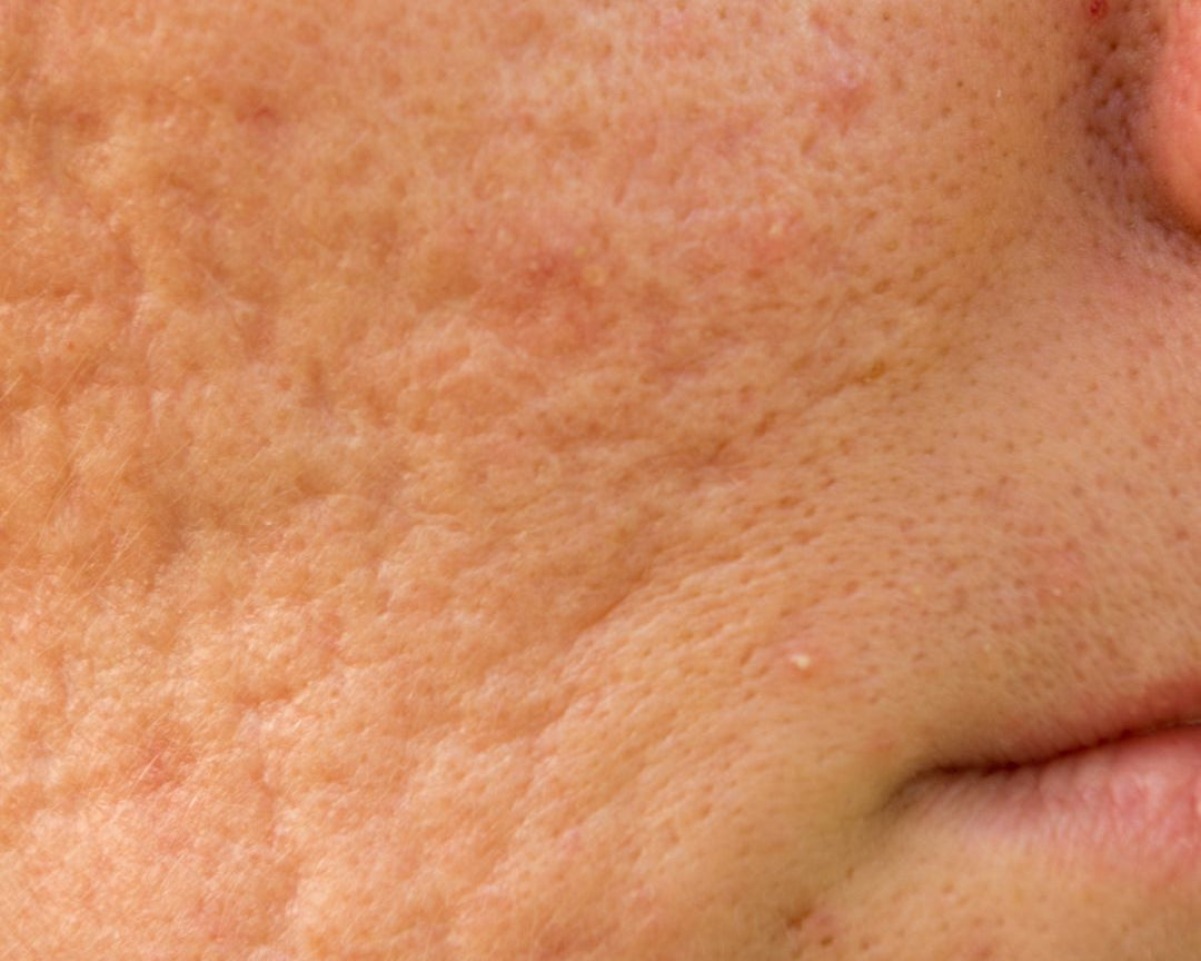 Les pores dilatés, comment s'en débarrasser ? - Novëm