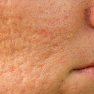 Les pores dilatés, comment s'en débarrasser ? - Novëm