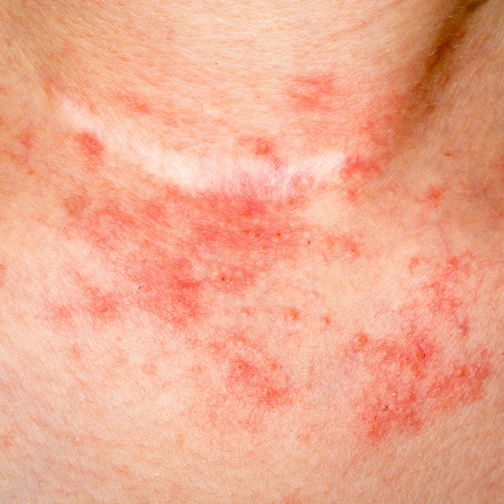 Peut-on Soigner l'Eczéma avec des Produits Naturels ? L'Histoire Derrière l'Huile de Noix - Novëm