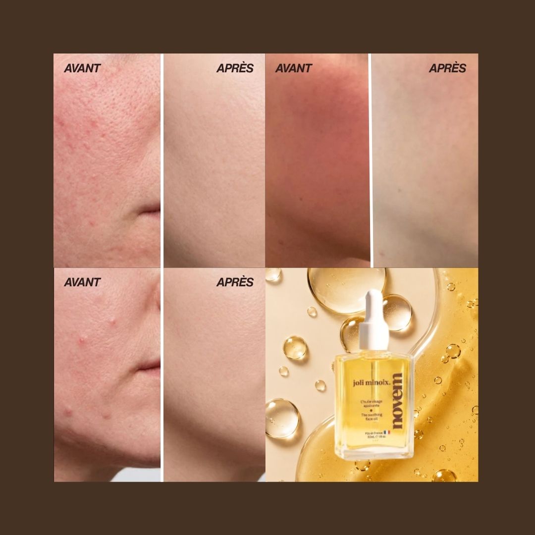 Soothing oil - anti-redness