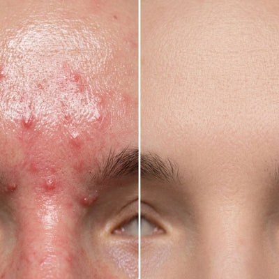 Soothing oil - anti-redness