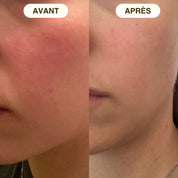 creme visage contre rougeurs